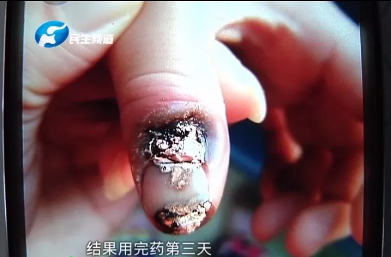 8岁男童烂指甲,8岁男童指甲烂掉