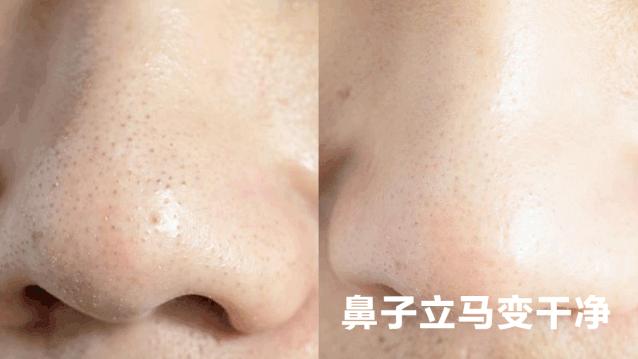 严重的黑头怎么处理教程,反复黑头的原因和解决方法