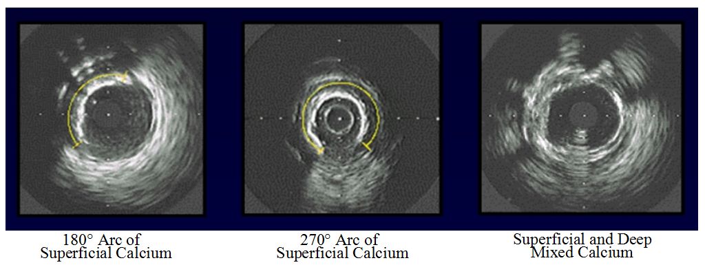 主动脉及冠状动脉钙化是什么病变,冠状动脉钙化影像学表现