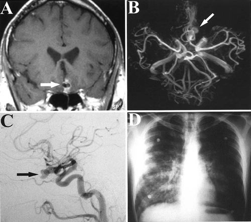 常见潜水疾病,潜水多深才会得潜水病