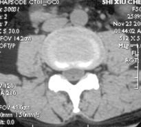 一分钟带你了解腰椎狭窄,椎管狭窄症知识大全