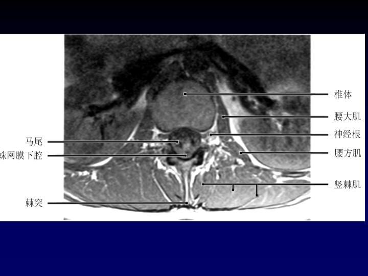 一分钟带你了解腰椎狭窄,椎管狭窄症知识大全