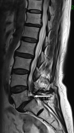腰椎滑脱怎样做有氧康复训练,腰椎滑脱康复治疗预后