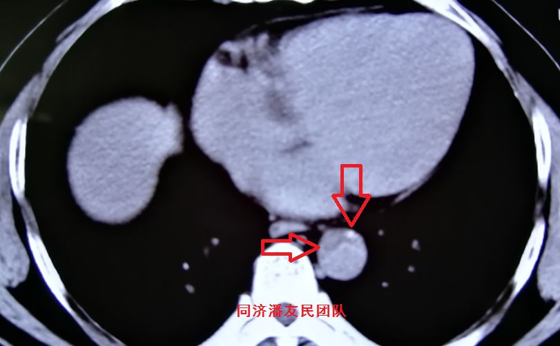 主动脉夹层如何快速确诊,确诊主动脉夹层最可靠办法