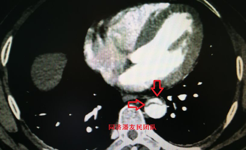 主动脉夹层如何快速确诊,确诊主动脉夹层最可靠办法