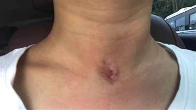 贴了三伏贴后没起水泡发红发痒,贴艾草贴以后身体发痒起红疹