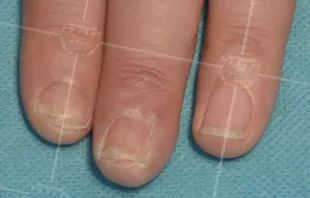 灰指甲致癌吗,灰指甲美甲的禁忌