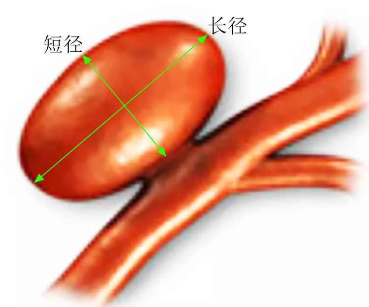 柳暗花明·第58期｜颅内动脉瘤栓塞时弹簧圈的选择（一）