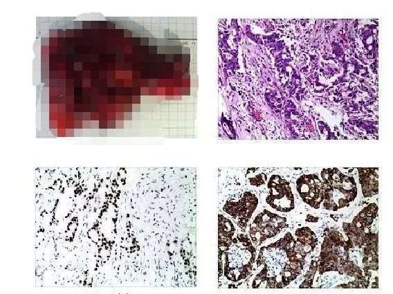 肺部肿瘤切除手术四天内出院？