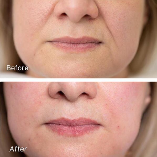 法令纹和眼纹怎么才能有效改善,法令纹贴眼贴有用吗