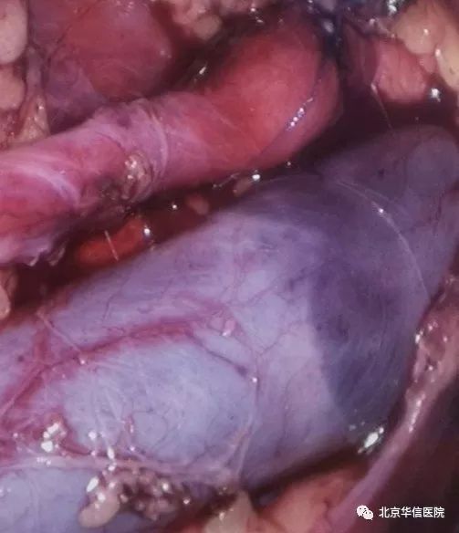 微创技术显神威!泌尿外科成功为先心术后患儿实施腹腔镜右输尿管复位矫形术