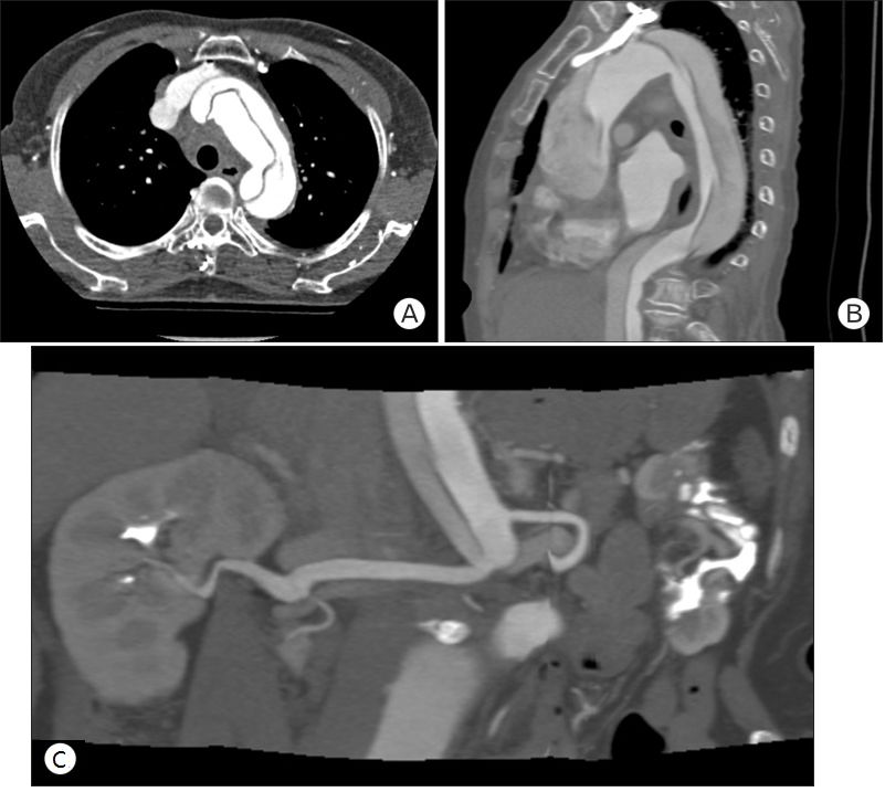 胸疼还有一个坑,胸痛症状缓解可能是陷阱