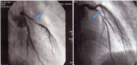 胸疼还有一个坑,胸痛症状缓解可能是陷阱