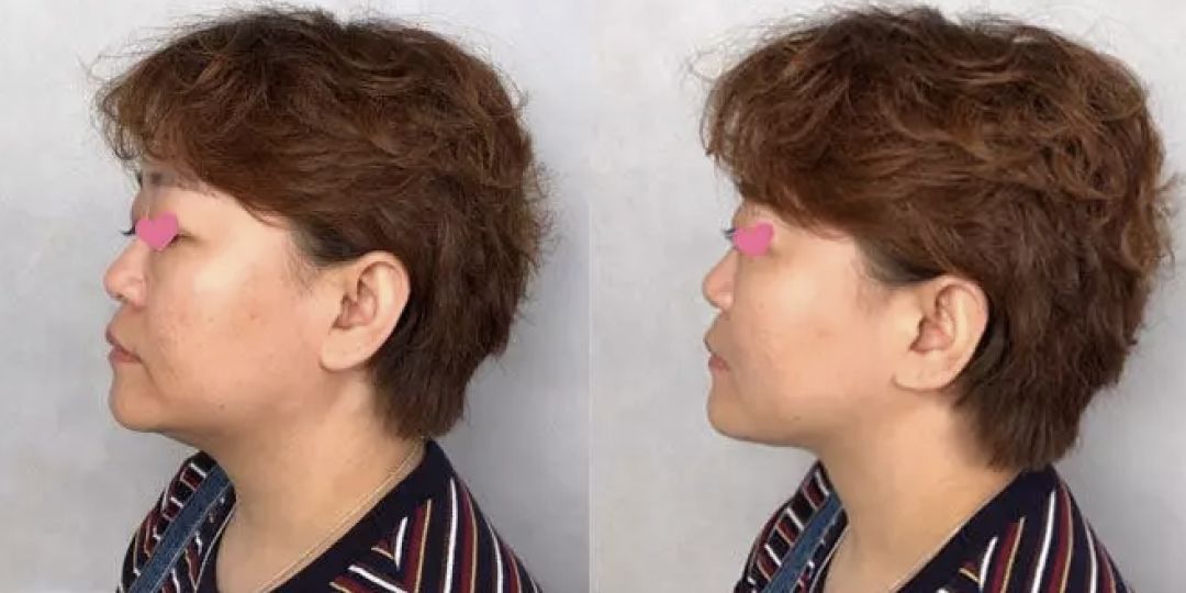 不削骨改变脸型,不削骨变脸型