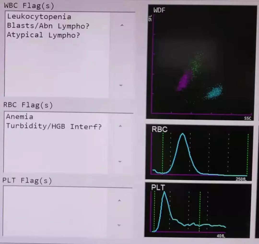 全血细胞减少就是白血病,全血细胞减少性白血病