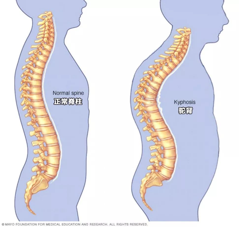 背背佳矫正驼背书包,驼背书包怎么挑选