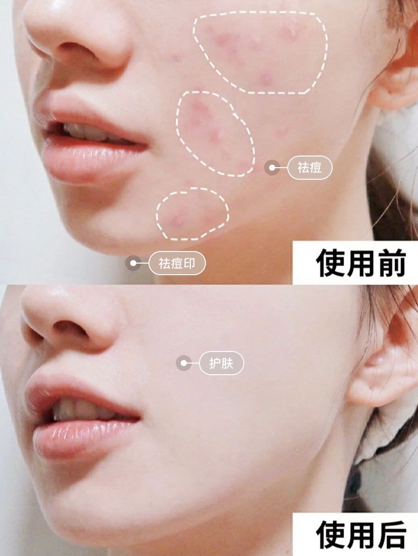 可美金箔祛痘螨虫皂,除螨皂能祛螨虫吗