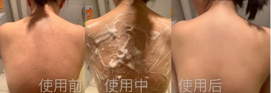 可美金箔祛痘螨虫皂,除螨皂能祛螨虫吗