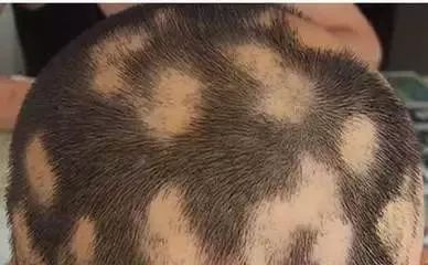 鬼剃头是怎么造成的,鬼剃头的原因及解决方法