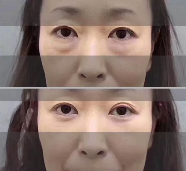 解决眼袋只需3步,不管眼袋多严重用点它