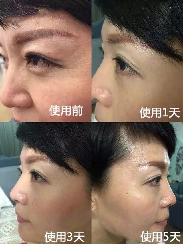 解决眼袋只需3步,不管眼袋多严重用点它