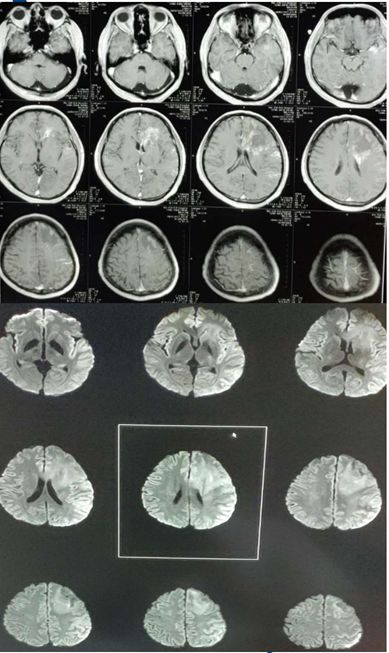 Rasmussen脑炎、结核性肉芽肿、脑发育性静脉畸形丨3分钟读片·第13期,下）