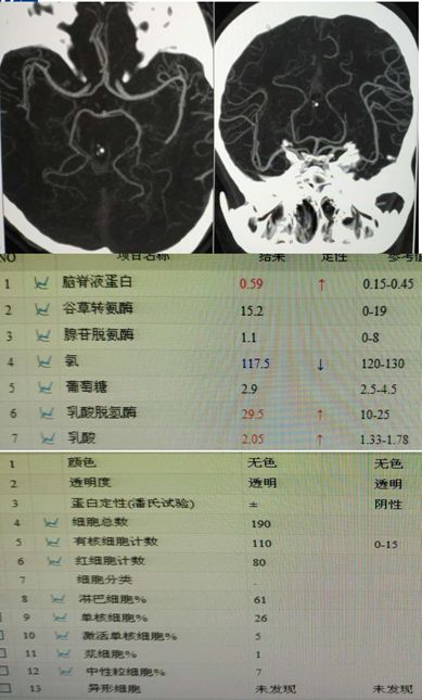 Rasmussen脑炎、结核性肉芽肿、脑发育性静脉畸形丨3分钟读片·第13期,下)