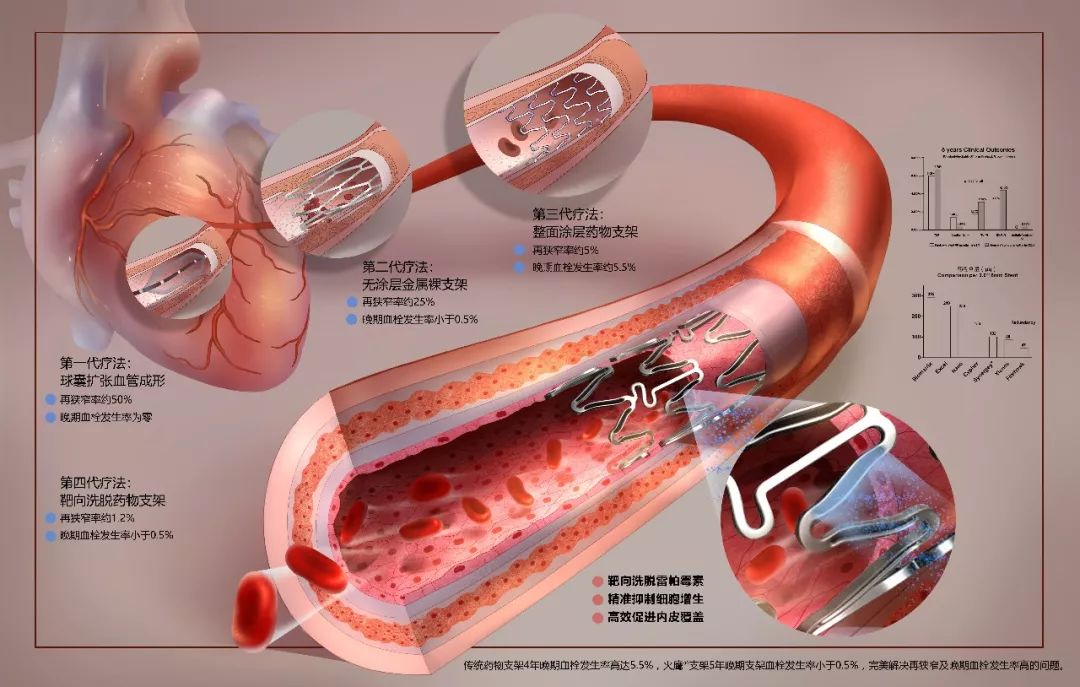 美国JACC子刊发布中国火鹰心脏支架最新临床数据，2年随访结果持续展现国际顶尖产品特性丨临床大发现