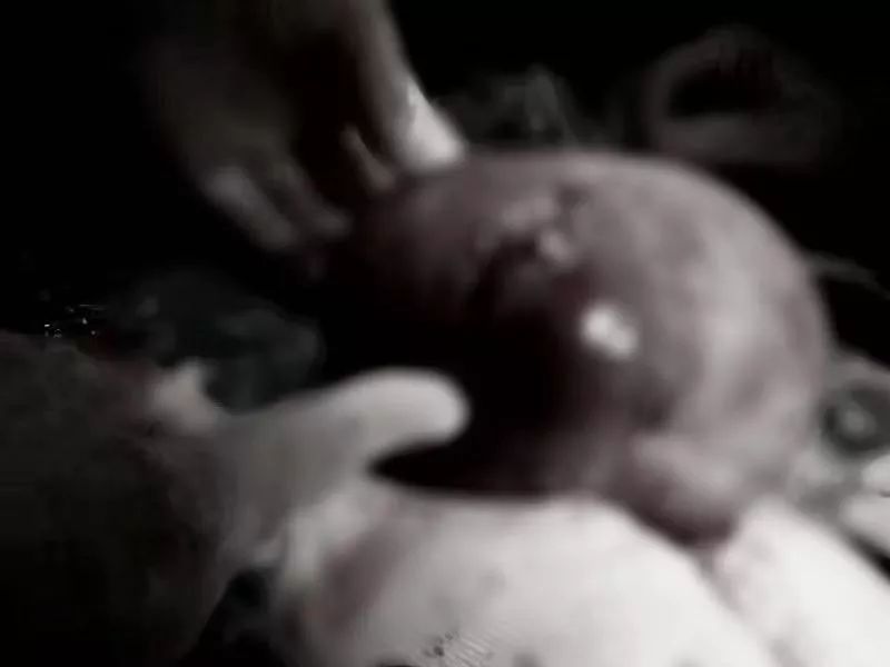 42岁大妈肚子突出如5月身孕，巨大瘤子在子宫内扭转