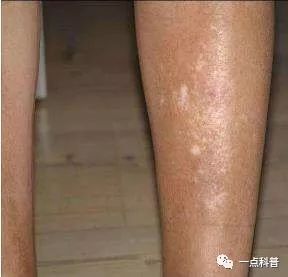 老年人皮肤癌是怎么得的,老人脸上长肉粒是皮肤癌吗