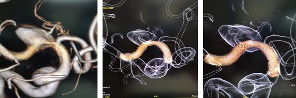 治疗颅内动脉瘤新型密网支架,pipeline治疗椎动脉夹层动脉瘤