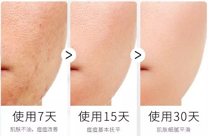 痘痘闭口里面有油脂,鼻子上的痘痘是青春痘还是粉刺