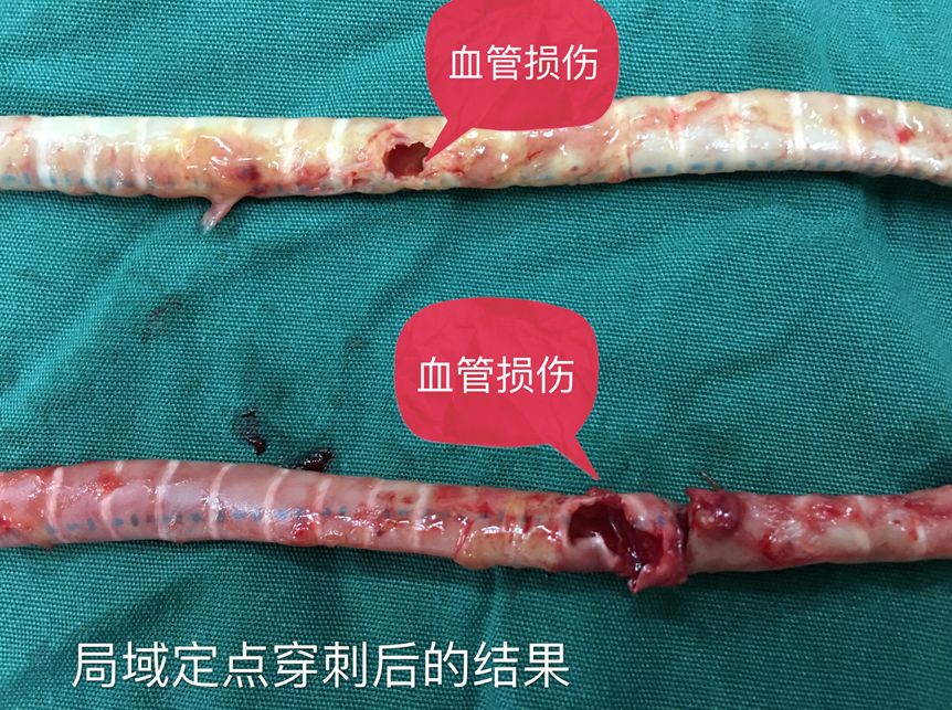 血透动静脉内瘘手术三种术式图解,血透室动静脉内瘘穿刺及护理