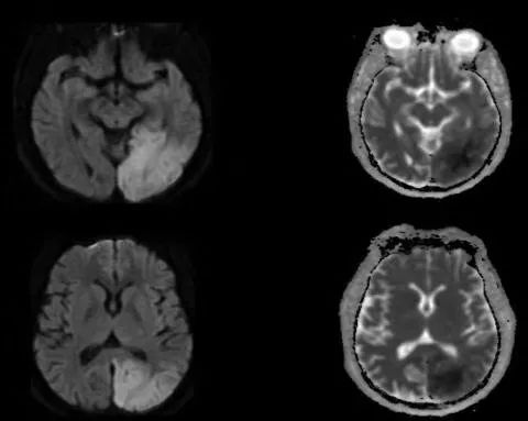 平山病、MELAS、MVNT、ODS丨3分钟读片·第15期
