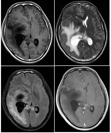 平山病、MELAS、MVNT、ODS丨3分钟读片·第15期