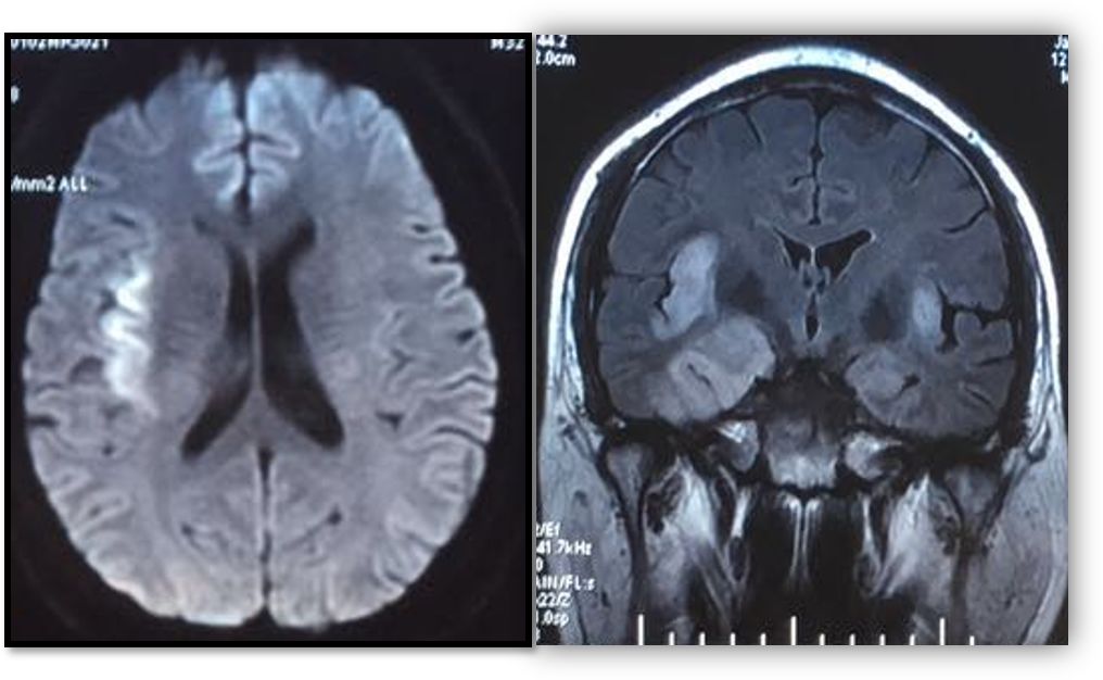 Whipple病、纹状体手、神经结节病、脱髓鞘假瘤丨3分钟读片·第16期