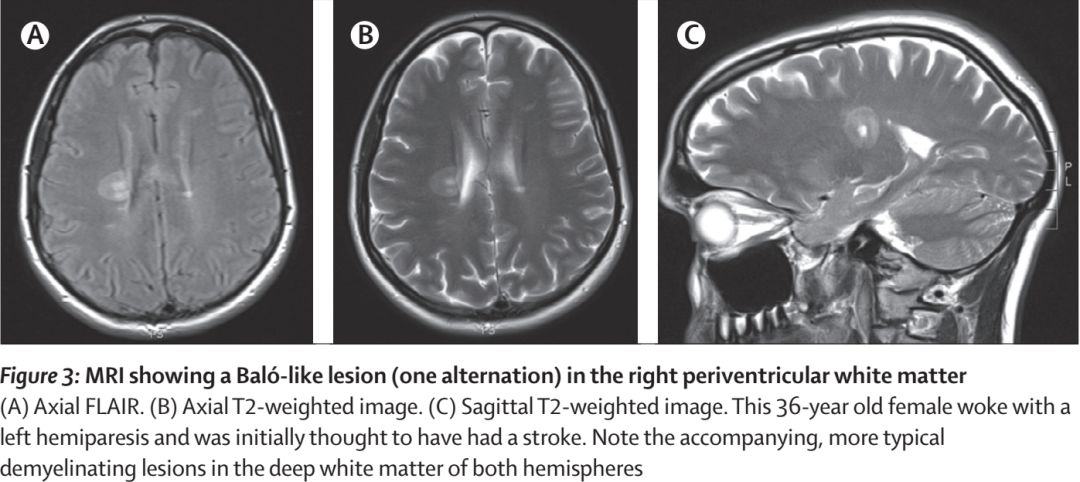Whipple病、纹状体手、神经结节病、脱髓鞘假瘤丨3分钟读片·第16期
