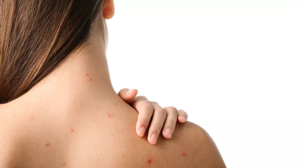 背上长痘痘的原因和解决方法,背上长痘痘的原因和解决方法医生