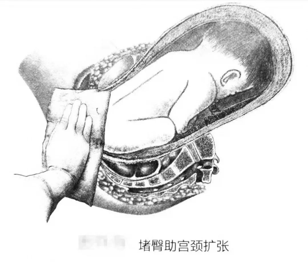 胎儿臀位分娩过程,臀位阴道分娩何时堵臀