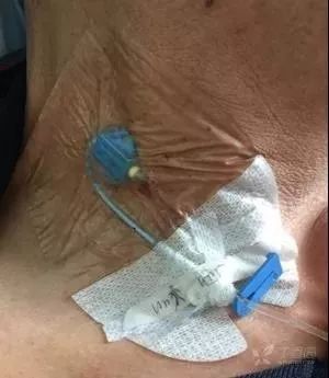 留置针u型敷贴正确撕法,留置针正确固定图片ppt