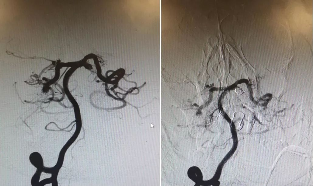 物华天宝·第12期｜复发多发动脉瘤合并烟雾病的支架辅助弹簧圈栓塞治疗