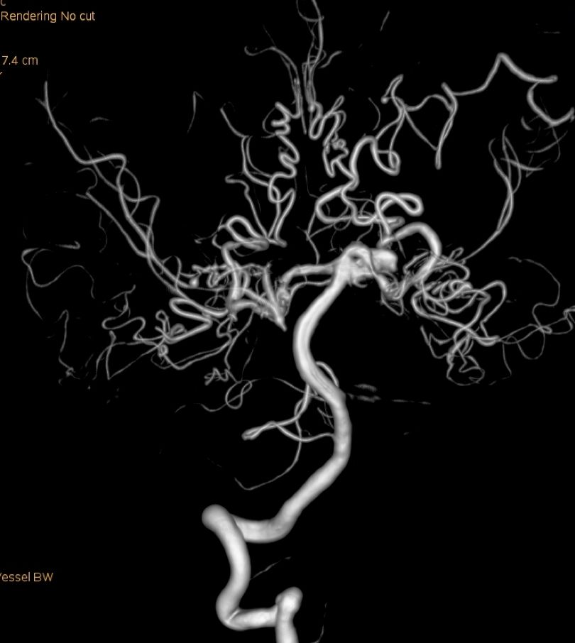 物华天宝·第12期｜复发多发动脉瘤合并烟雾病的支架辅助弹簧圈栓塞治疗