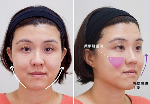 脸下垂提拉紧致图片,提拉下颚线打造小v脸
