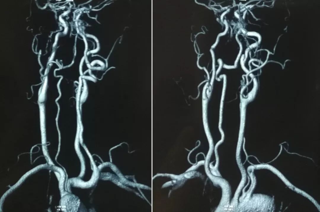 中医治疗脑夹层动脉瘤,3d演示夹层动脉瘤支架治疗