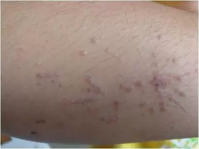 鸡眼和疣如何区别,掌跖疣是不是鸡眼