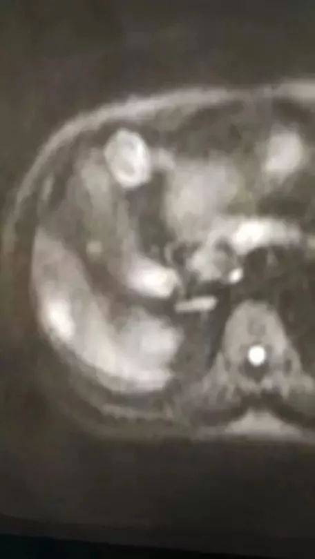 胰腺癌误诊黄疸肝炎,急性黄疸性肝炎住院治疗没效果