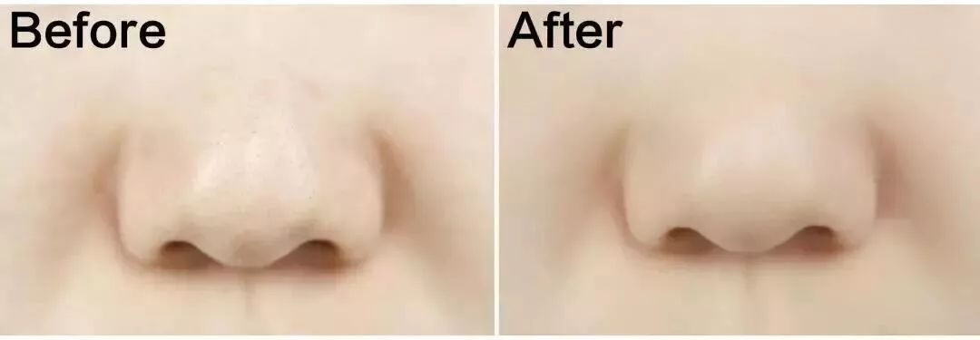 去黑头鼻贴推荐黑头导出液,去黑头的最好办法告别草莓鼻