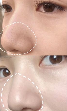 去黑头鼻贴推荐黑头导出液,去黑头的最好办法告别草莓鼻