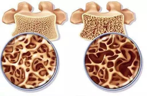 骨质疏松症康复指南推荐一览,中国老年骨质疏松症诊疗指南2023