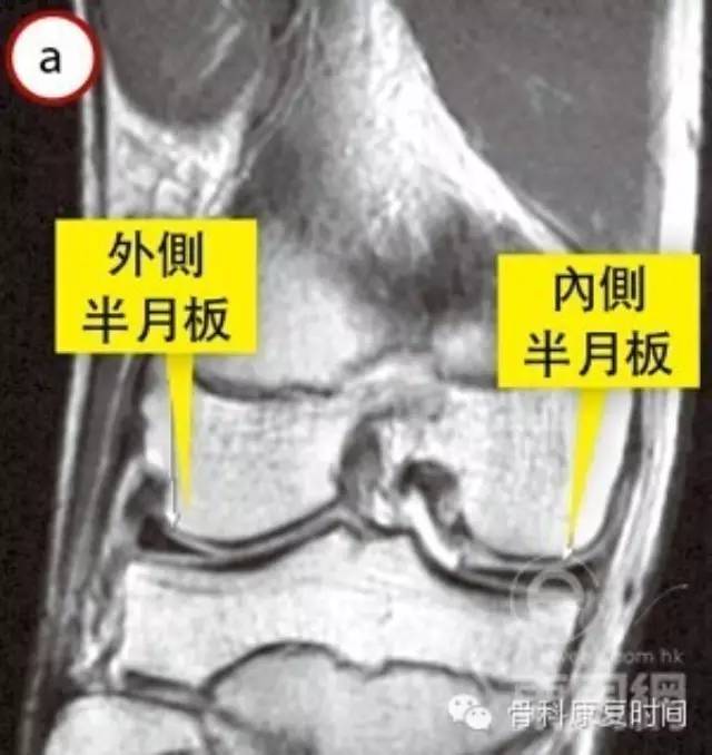 「康复时间」半月板缝合修复术后如何康复？
